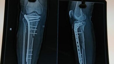 कशी केली कोरोना रुग्णावर पायाच्या हाडाची शस्त्रक्रिया