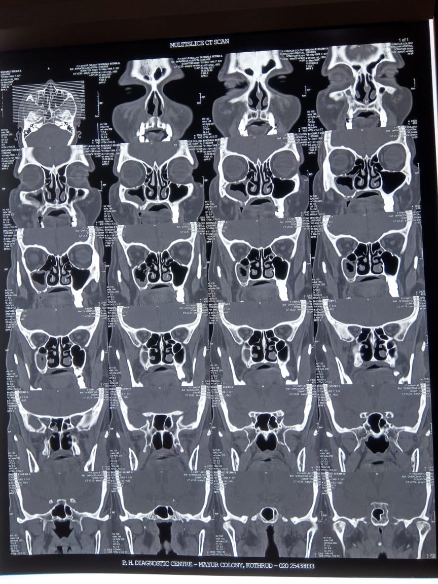 म्युकोरमायकोसिस आजाराने काळजी वाढली ; लवकर निदान व अचूक उपचार गरजेचे..