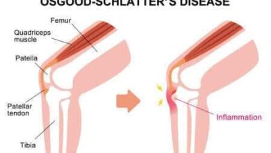 किशोरवयीन मुलांमध्ये  गुडघेदुखीचा आजार का वाढतोय ; दुर्लक्ष करू नका (osgood schlatter disease)