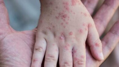 पुण्यात गोवरचा शिरकाव ; पिंपरी-चिंचवडमध्ये एकाच दिवशी पाच रुग्ण