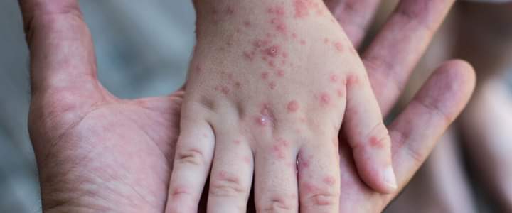 पुण्यात गोवरसाठी विलगीकरण कक्ष